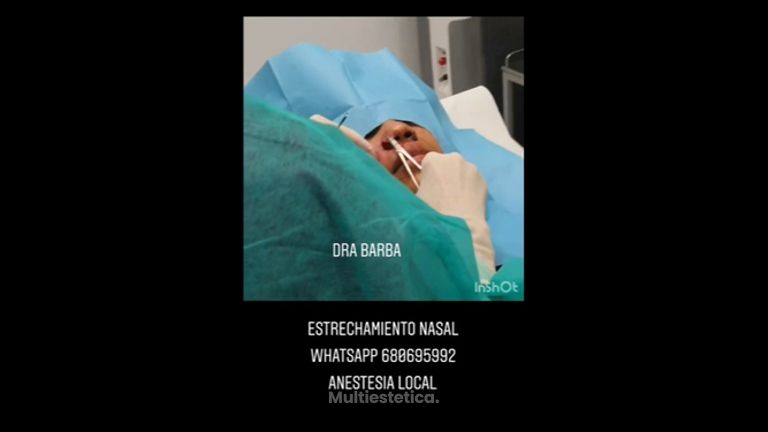 Rinoplastia - Doctora Barba Martínez