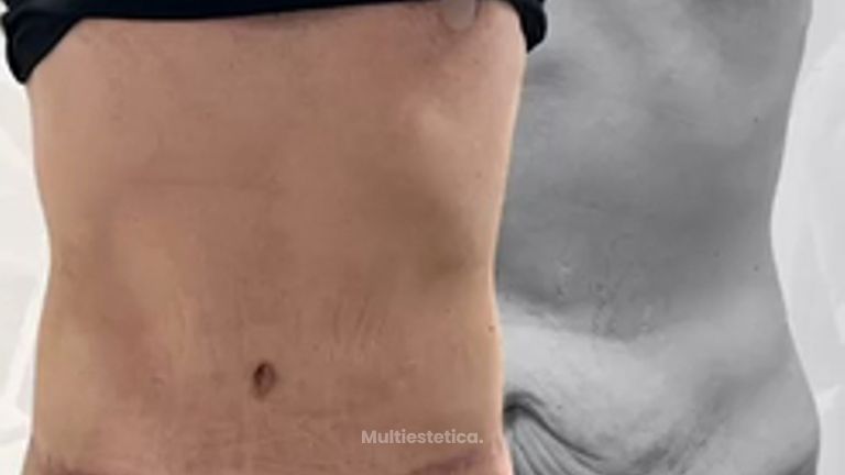 Abdominoplastia - Dr. Yvan Pacheco