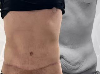 Abdominoplastia - Dr. Yvan Pacheco