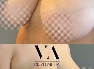 Dr. Vernetta - Reducción de senos