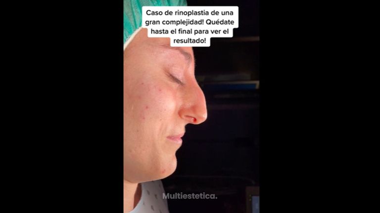 Rinoplastia - Dr. Alberto Candau