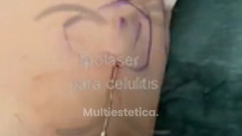 lipolaser para celulitis