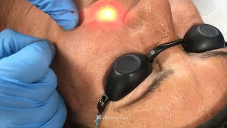Clínica Dr. Omar López - Láser Endolift
