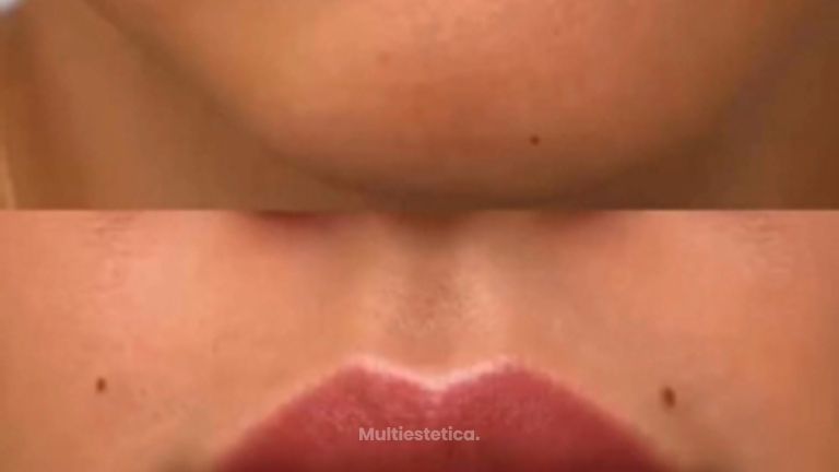 LABIOMODELACIÓN - Clínicas Dra. Matas