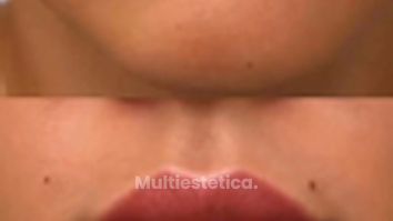 LABIOMODELACIÓN - Clínicas Dra. Matas