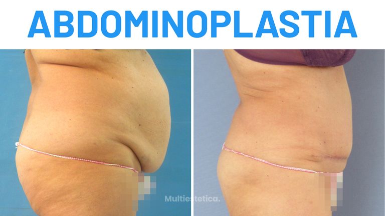 Abdominoplastia – Queti