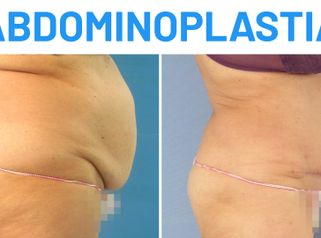 Abdominoplastia – Queti