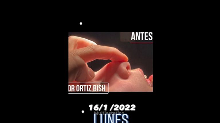 Rinoplastia - Dr Francisco Ortiz Bish