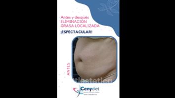 Eliminación grasa localizada - Cenydiet