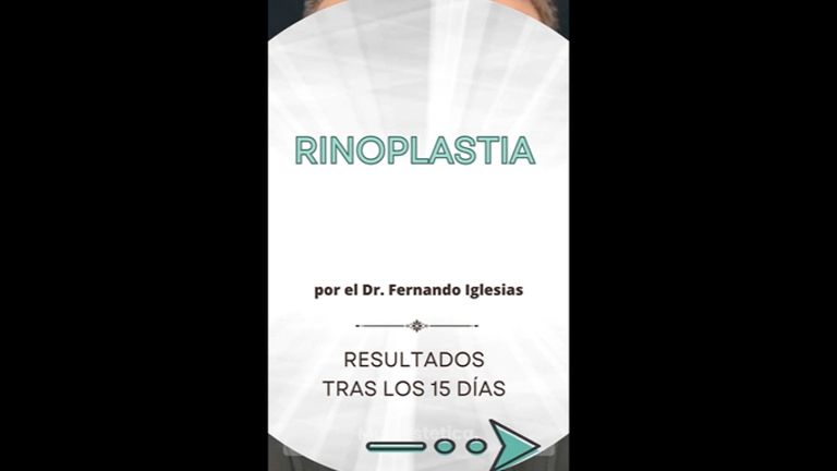 Rinoplastia - Clínica Montecarmelo