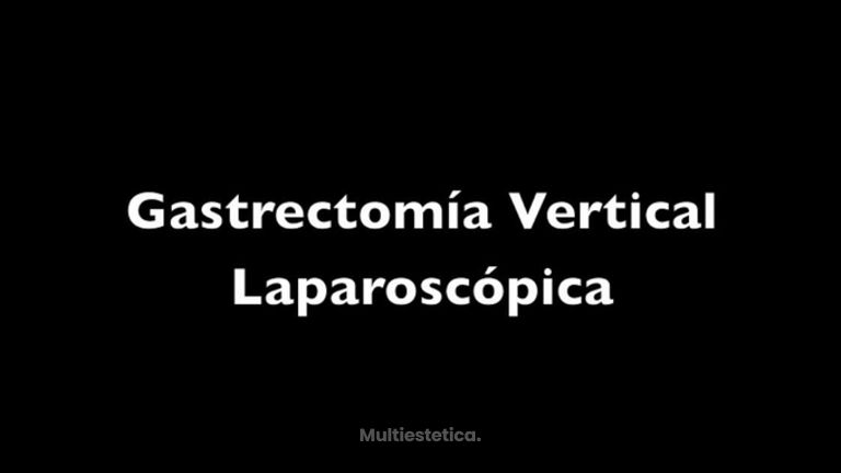 Gastrectomía Vertical Laparoscópica
