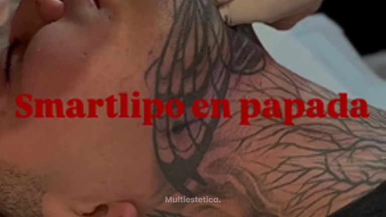 ✨ Dile adiós a la papada en una sola sesión con Smartlipo ✨