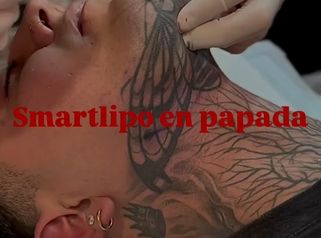 ✨ Dile adiós a la papada en una sola sesión con Smartlipo ✨