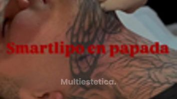 ✨ Dile adiós a la papada en una sola sesión con Smartlipo ✨