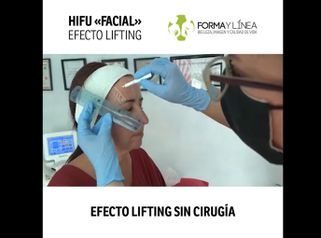 Tratamiento facial - lifting sin cirugía HIFU - Forma Y Línea Murcia