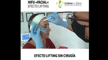 Tratamiento facial - lifting sin cirugía HIFU - Forma Y Línea Murcia