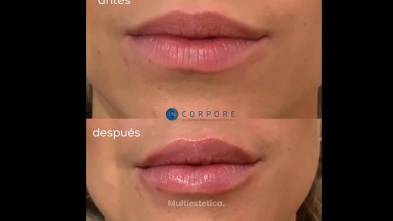 Aumento de labios - Dr. Juan Enrique Pérez Enríquez