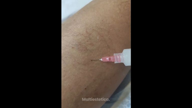 Tratamiento varices - IMSEI CLINIC