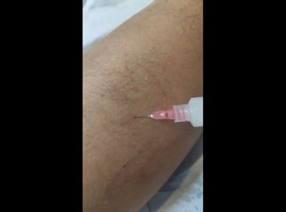 Tratamiento varices - IMSEI CLINIC