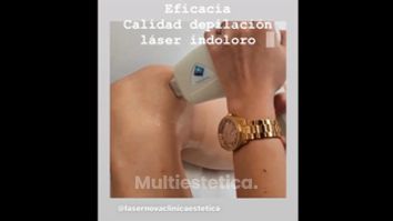 Depilación láser - Clínica Lasernova