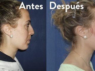 Rinoplastia Sevilla | Experiencia personal sobre su operación de nariz