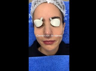 Eliminación de ojeras - Clínica Vega