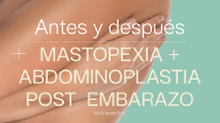 Antes y después de mastopexia y abdominoplastia post embarazo