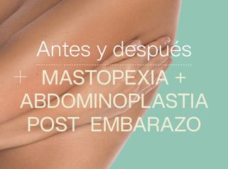 Antes y después de mastopexia y abdominoplastia post embarazo