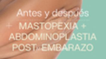 Antes y después de mastopexia y abdominoplastia post embarazo