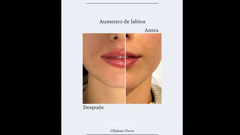 Aumento de labios - Clínicas Vieco