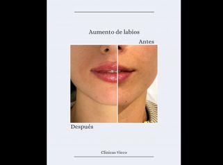Aumento de labios - Clínicas Vieco