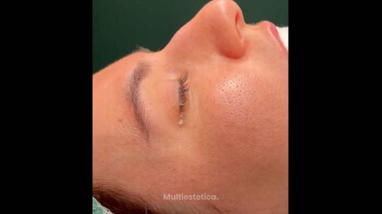 Rinoplastia - Dr. Pérez Villar