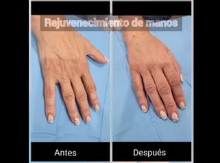 Tratamientos antimanchas - Dra. Any Ramírez