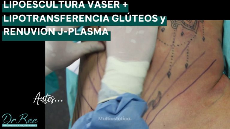Lipo Vaser - Dr Ree