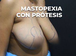 Mastopexia con prótesis - Clínica Opción Médica