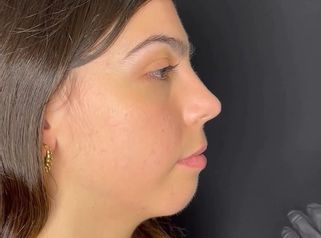 Armonización facial - Hakari Clinics