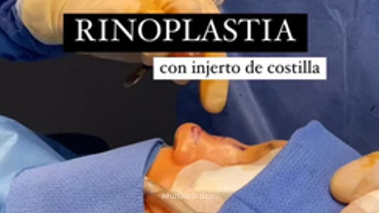 Rinoplastia - Clínica Dr. Jiménez