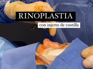 Rinoplastia - Clínica Dr. Jiménez