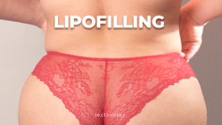 Lipotransferencia - Clínica Opción Médica