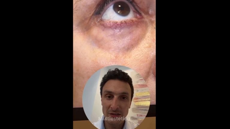 Blefaroplastia - Clínica Pérez Espadero