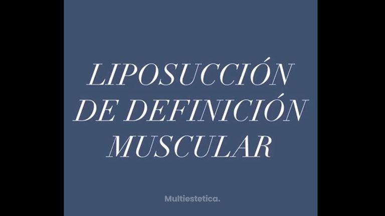 LIPOSUCCIÓN DE DEFINICIÓN MUSCULAR