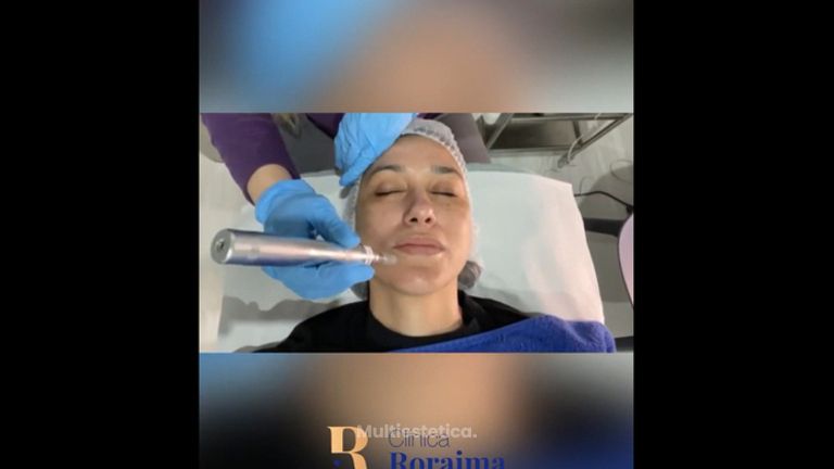 Rejuvenecimiento facial - Dr. Juan Sergio Fernandes Andrade