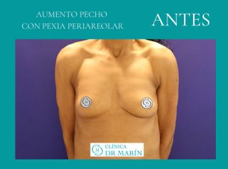 Aumento de pecho - Clínica Dr. Pascual Marín