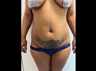 Abdominoplastia - Clínica Yenkra