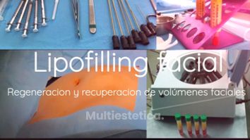 Lipofilling - Clínica Montecarmelo