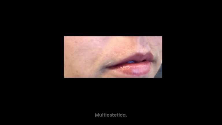 Aumento de labios - Dr. Pérez Villar