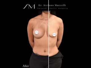 Aumento de pecho - Dr. Stefano Marcelli