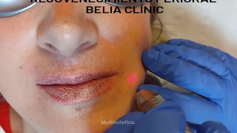 Eliminar arrugas - Belia Clinic