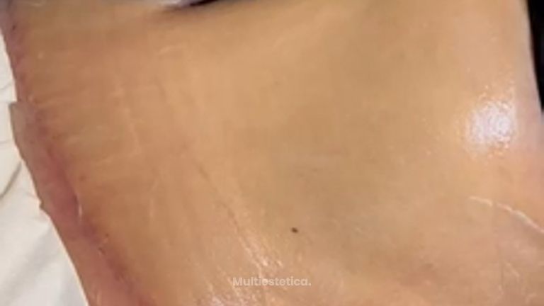 Y este de Indiba post operatorio - Clínica Díaz Caparrós
