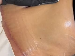 Y este de Indiba post operatorio - Clínica Díaz Caparrós